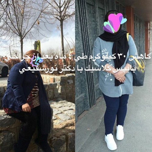 جراحی لاغری دکتر سجاد نور شفیعی هزینه جراحی لاغری | شرایط جراحی لاغری | جراحی لاغری چیست | جراحی لاپاراسکوپی جراحی لاغری | جراحی فتق مشهد | عمل جراحی لاغری